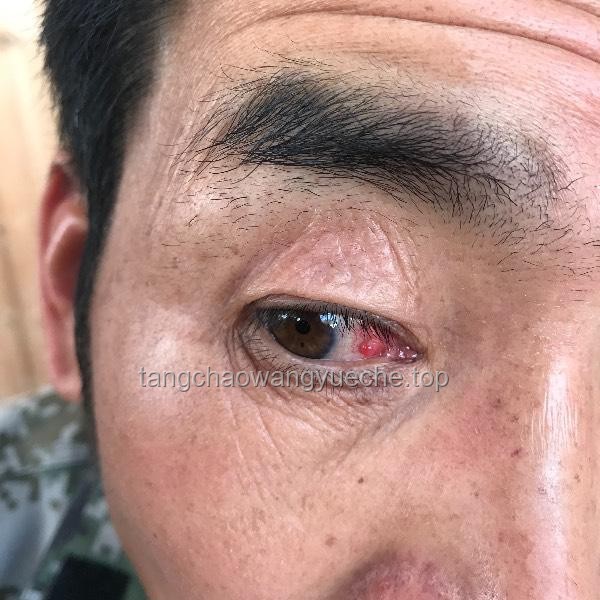 **右眼狂飆淚？警惕！這可能是淚囊里長了瘤子的信號**