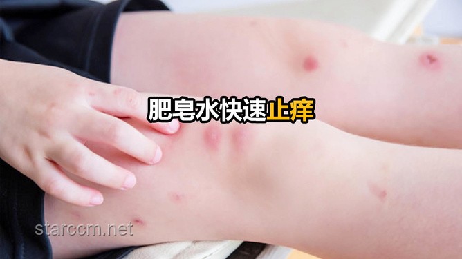 **被蚊子咬了能迅速止癢的4個方法，希望大家都用不上！**