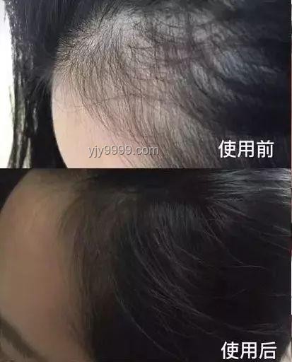 洗頭后這個習慣會加重脫發：避免錯誤干發方式