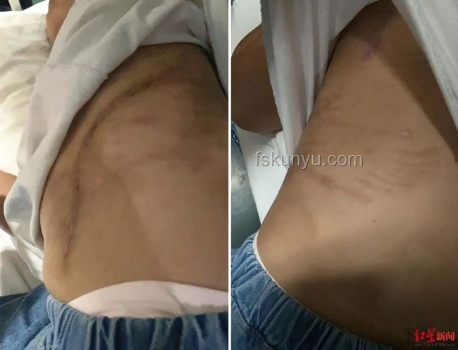 女生河邊散步遇蝮蛇咬傷應急處理指南