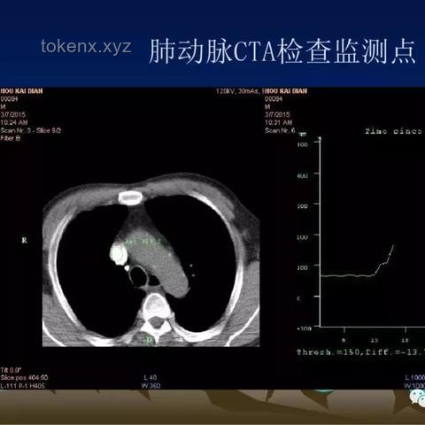 男子運動拉伸致肺動脈栓塞險猝死：健身行業安全警鐘