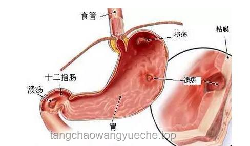 老人胃炎誤切全胃？醫院回應背后的真相與思考