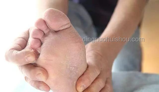 皮膚變厚與腳氣的對比分析