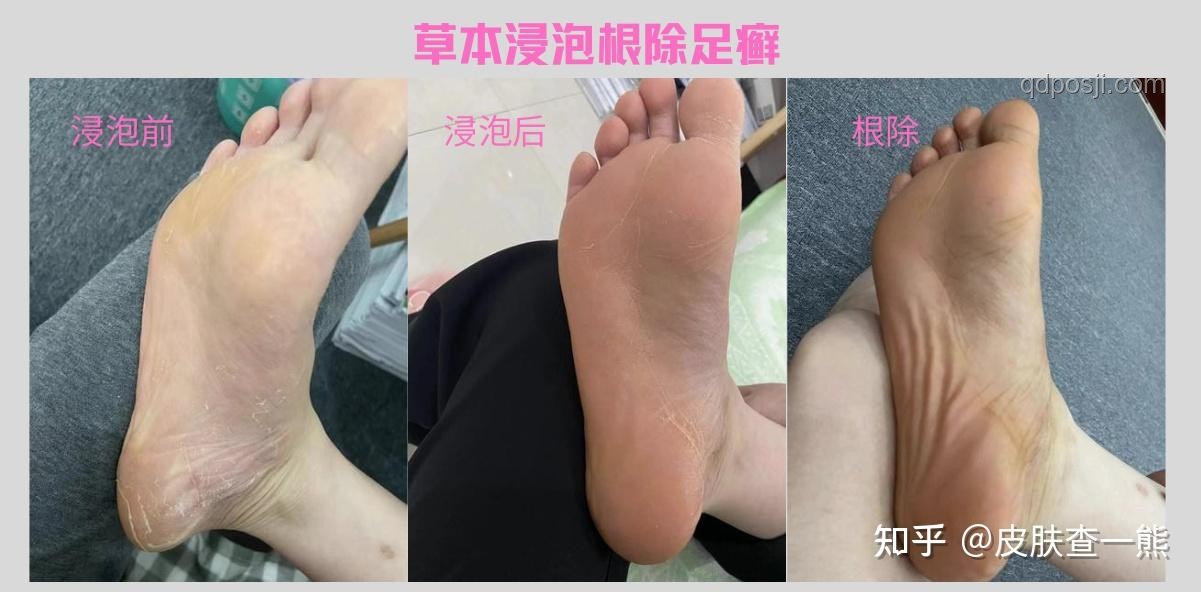 皮膚變厚型腳氣治療案例研究
