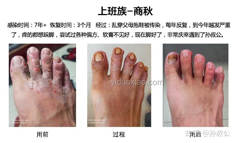 皮膚變厚型腳氣治療案例研究