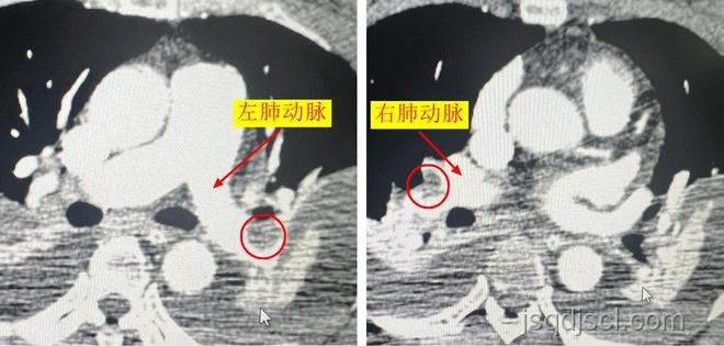 女子長途飛行后心跳驟停，肺栓塞風險需警惕