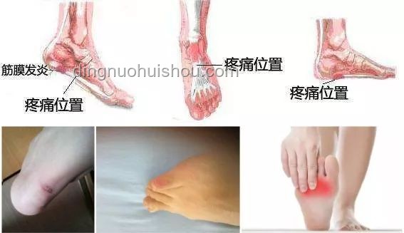 洞洞鞋與常規鞋對比：女子常穿洞洞鞋致足底鈣化行走困難案例分析